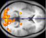 fMRI scan neuroimaging